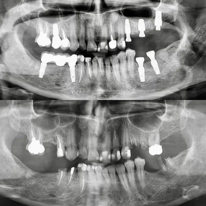 ایمپلنت آلمانی 1