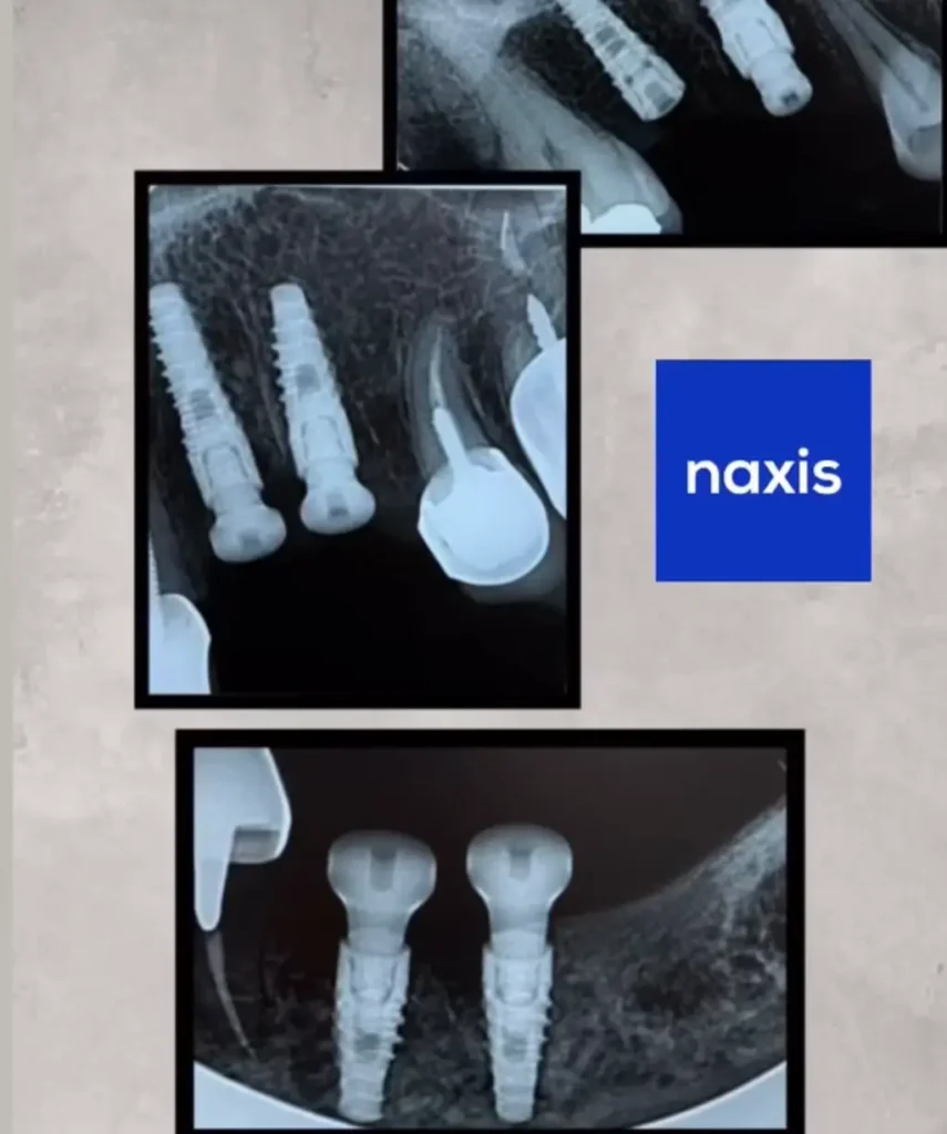 ایمپلنت های آلمانی